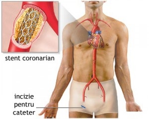 Angina pectorala si infarctul miocardic,cardiopatia ischemica